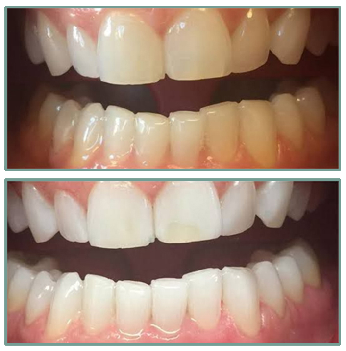 Teeth-Whitening