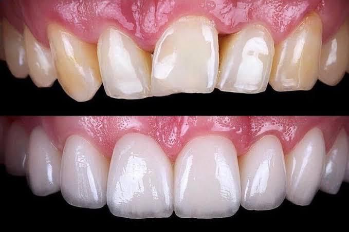 as-teeth