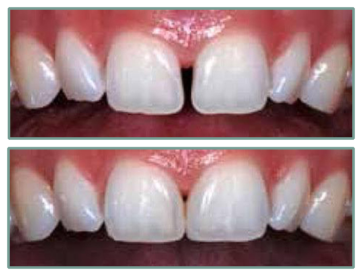 Composite Bonding Trudental