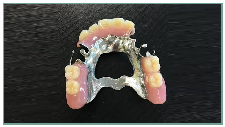 Partial Denture